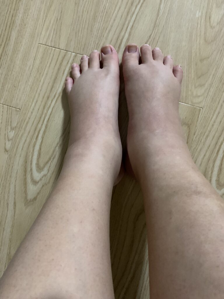 足の浮腫み